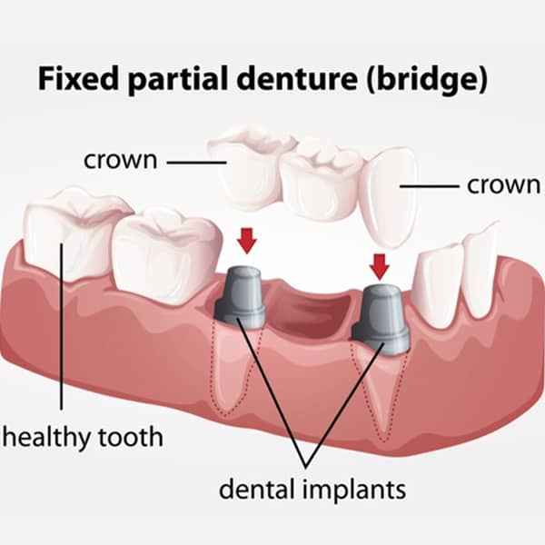dental bridges and dentures in Dearborn
