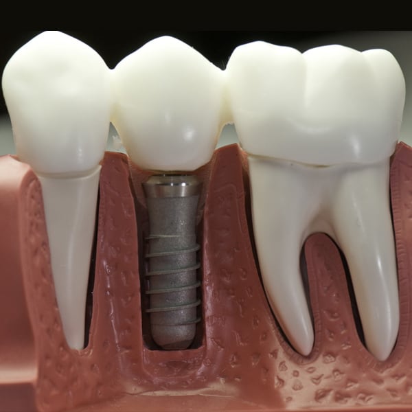 dental implants in Dearborn