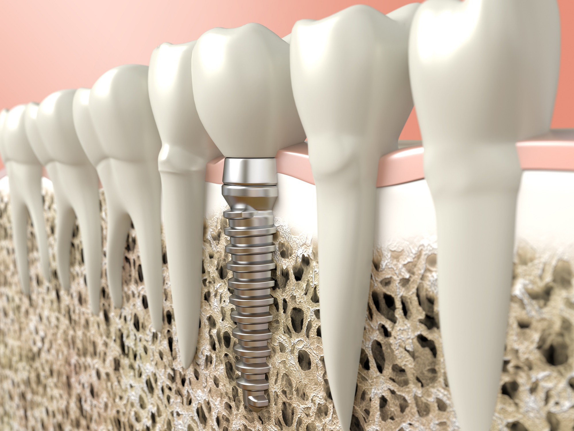 How Dental Implants Can Change Your Life?