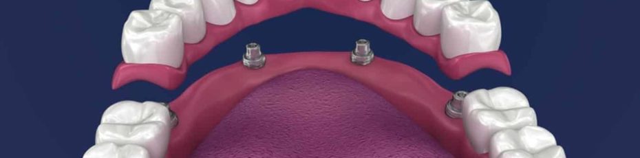 what are the pros and cons of wearing permanent dentures