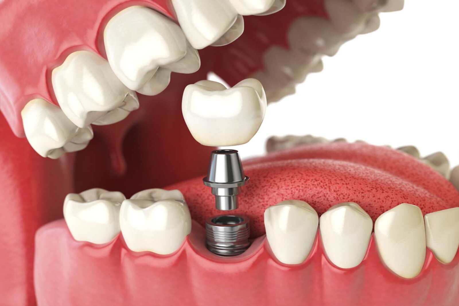 who do so many people choose dental implants