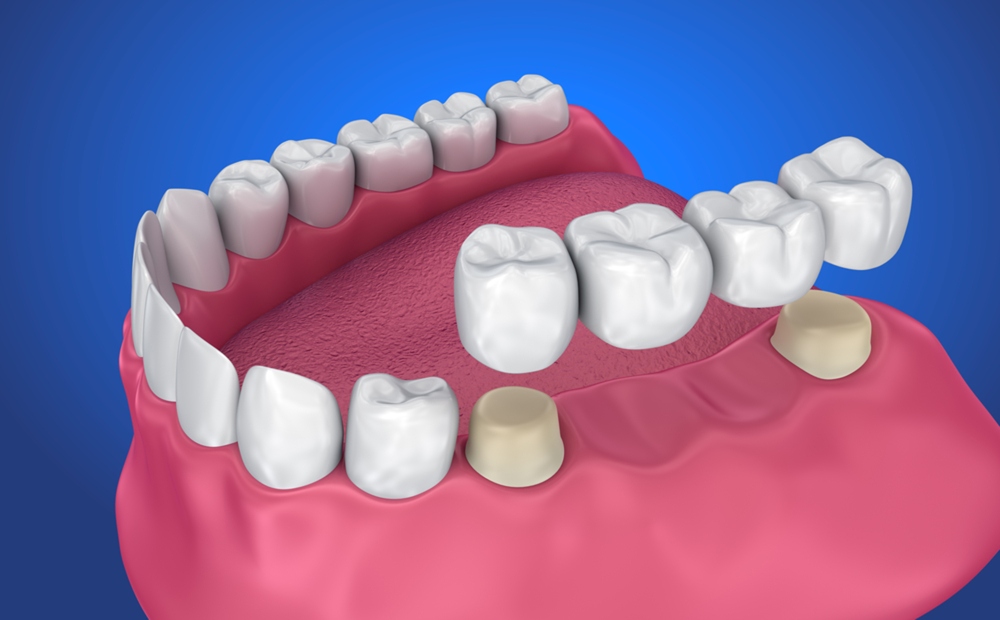 What You Should Know About Dental Bridges