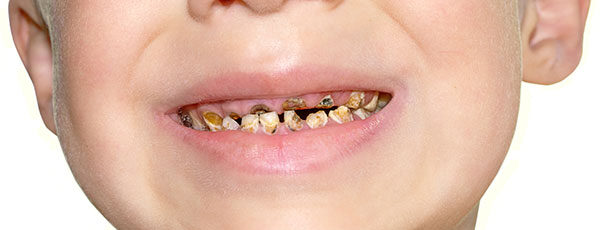 child have tooth decay
