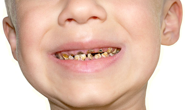 child have tooth decay