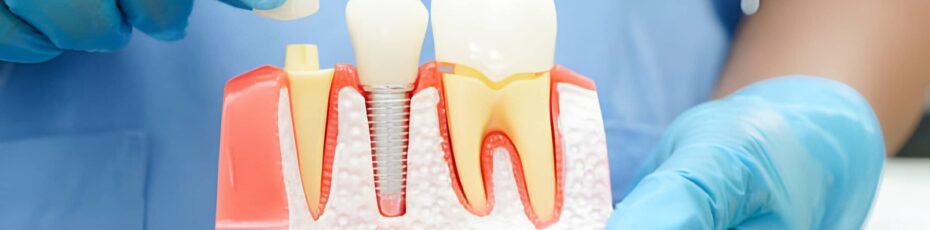 How Dental Implants Can Transform Your Confidence